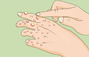 世界灾难：猴痘多发病例席卷全球，暂无有效治疗方案